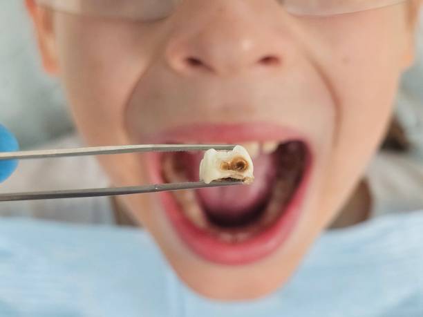 Best Emergency Tooth Extraction in Mosheim, TN