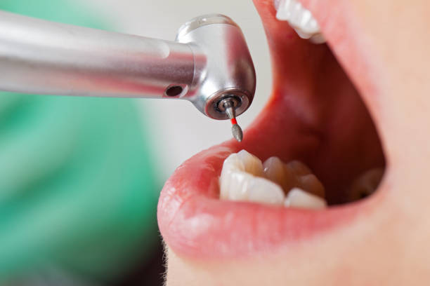 Best Emergency Wisdom Teeth Removal in Mosheim, TN